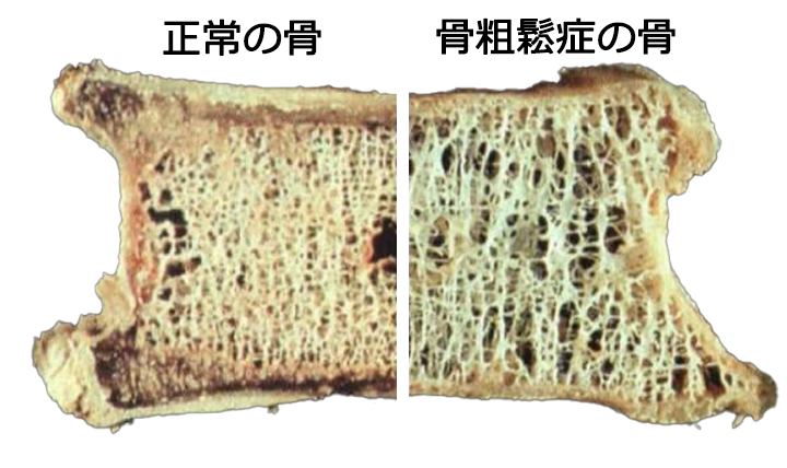 骨粗鬆症について